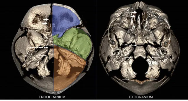 Understanding Skull Base Anatomy: Structure, Functions, and Clinical Significance